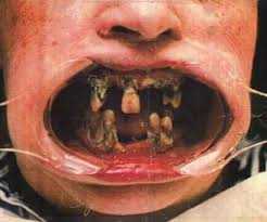 [http://t1.gstatic.com/images?q=tbn:m3lI33pq-gNSzM:www.babble.com/CS/blogs/strollerderby/2008/01/23-End/bad-teeth.jpg]