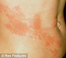 shingles virus