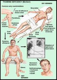 \x3cb\x3eberiberi\x3c/b\x3e symptoms image