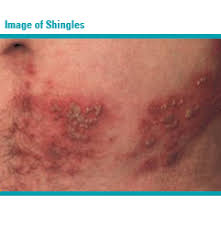 shingles virus