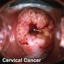 The first signs of cervical