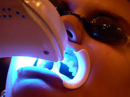  Preparing for a Laser Teeth Whitening Procedure