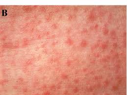 Measles: Beware