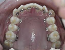 Lingual Braces