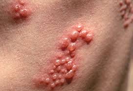 shingles virus