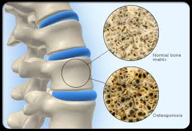 photo of weak bones