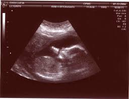 baby in ultrasound 4t4w Ultra sound pictures.