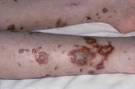 meningococcal septicemia,