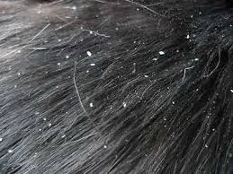 dandruff