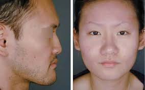 rhinoplasty