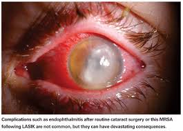 of endophthalmitis with