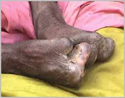 Leprosy Colony