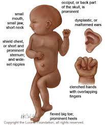 Syndrome Trisomy 18.