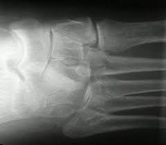 indications of Lisfranc injury