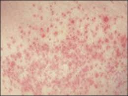 relief for a yeast infection