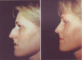 before and after rhinoplasty