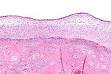 <b>Chorioamnionitis</b> - Wikipedia, the free encyclopedia