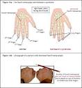 and <b>Kallmann's syndrome</b>