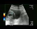 <b>Aborto Spontaneo</b>