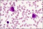 AML Acute <b>leukemia</b> quiz