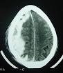 <b>ACUTE SUBDURAL HEMATOMA</b> see