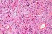 <b>Meningioma</b> - Wikipedia