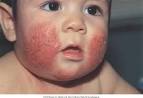 <b>Enfermedades</b> de la <b>piel</b> | Un