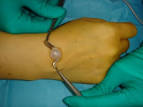 <b>Kyste</b> Arthro-Synovial du Poignet | Chirurgie de la Main