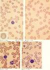 <b>Talasemia</b> minor: Comparación