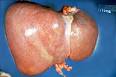 Dehlvi Naturals- what is <b>Hepatomegaly</b>,Herbal Supplements for
