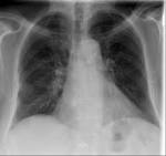 <b>Pulmonary embolism</b> with lung infarction | Image | Radiopaedia.