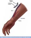 AV <b>Fistula</b> | See Jane Nurse
