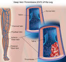 What is deep vein <b>thrombosis</b>?