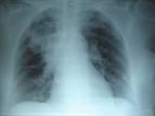 La <b>neumonía</b> es una infección