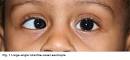 Special patterns of <b>strabismus</b>