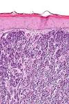 File:<b>Merkel cell carcinoma</b>