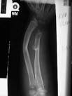 <b>Exostosis</b>: Clinical and