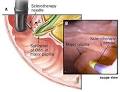 of <b>Oddi dysfunction</b>