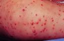 what-is-staph-<b>infection</b>.jpg