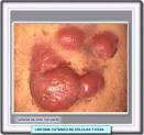 <b>Linfoma</b> De <b>Células T Periférico</b>; <b>Linfoma</b> de <b>Células T Periféricas</b>