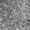 <b>Erdheim</b>–<b>Chester disease</b>