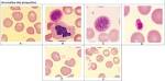 <b>Anomalies</b> des <b>plaquettes</b>.