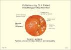 <b>malignant hypertension</b>.
