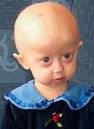 Progeria Patients May Get Hope