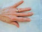 <b>Psoriatic Arthritis</b>