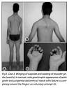 NCV and two CK samples proved