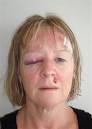 Clare Holden shows her <b>facial</b>