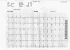 of long QT <b>syndrome</b> (LQTS)