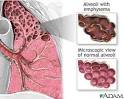 <b>Emphysema</b>