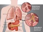 a-look-inside-cystic-fibrosis.jpg